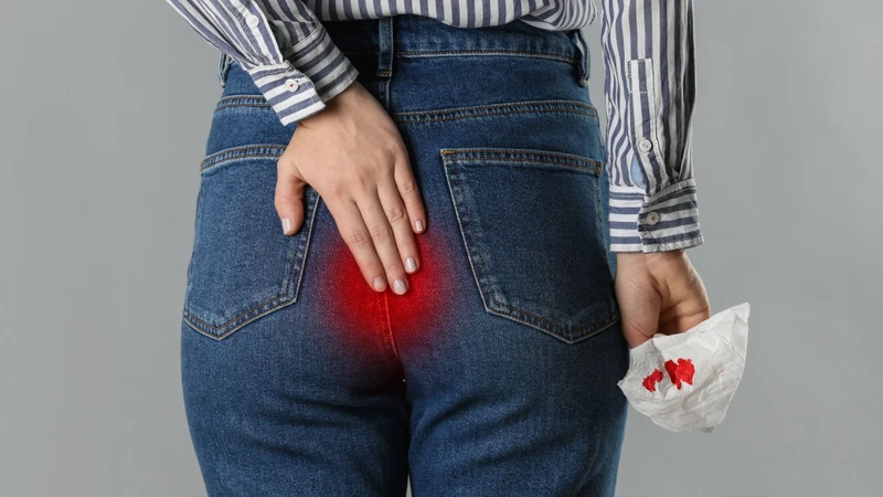 Chảy máu khi đi đại tiện là một triệu chứng của trĩ nội độ 2