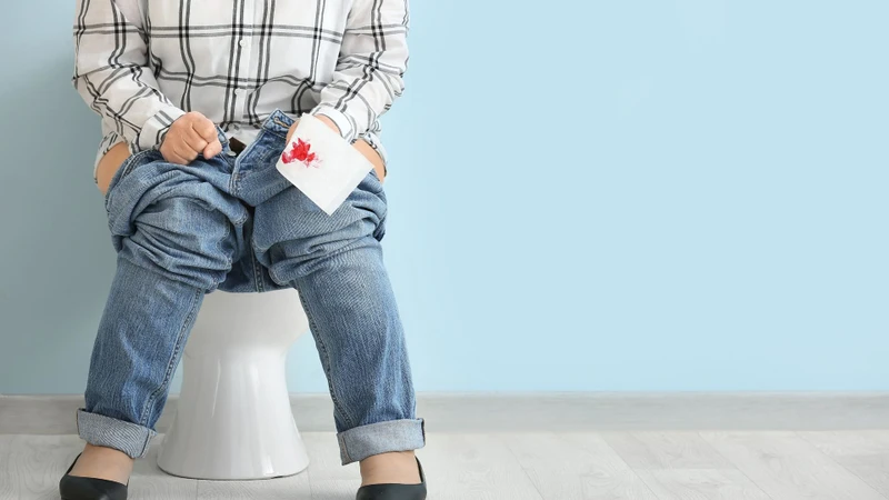 Đi ngoài ra máu tươi là triệu chứng thường gặp và biểu hiện sớm nhất của trĩ nội độ 1