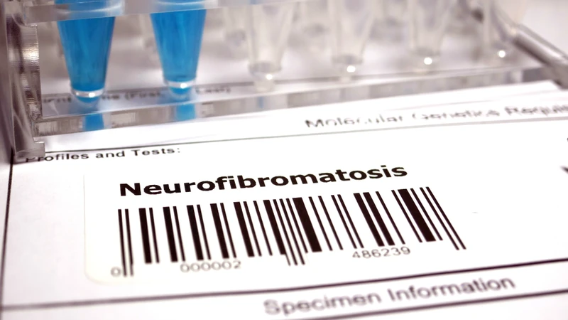 Người bệnh Neurofibromatosis type 2 có nguy cơ cao phát triển u dây thần kinh số 8 hai bên