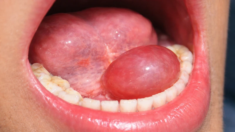 U nang dưới lưỡi quá to có thể gây đau và khó nuốt