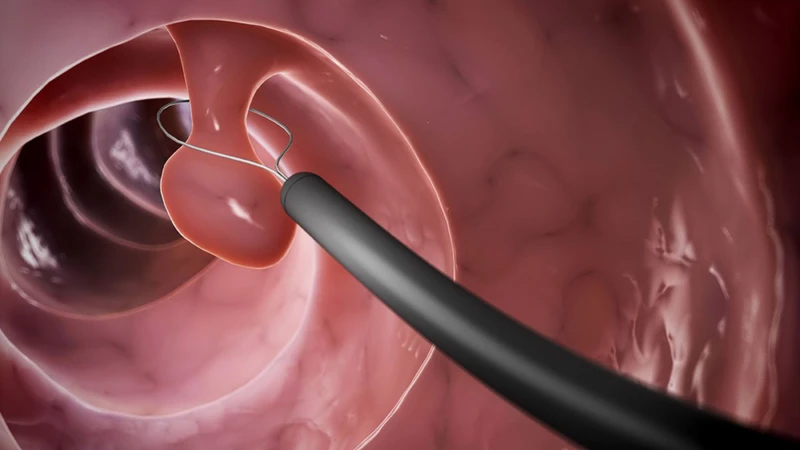 Tiền sử mắc polyp đại trực tràng là một trong những yếu tố nguy cơ