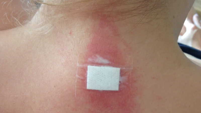 Sinh thiết da là một trong những phương pháp quan trọng để hỗ trợ chẩn đoán nguyên nhân của viêm da bong vảy