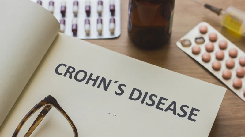 ệnh Crohn là một dạng bệnh viêm ruột mạn tính có thể ảnh hưởng đến bất kỳ đoạn nào của ống tiêu hóa, bao gồm cả đại tràng sigma