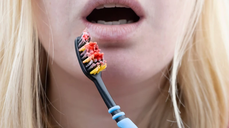 Viêm lợi dễ chảy máu khi chải răng, dùng chỉ nha khoa hoặc thăm khám nha khoa