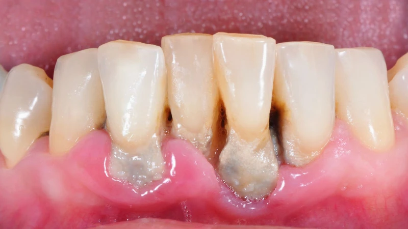 Mảng bám vi khuẩn và cao răng là nguyên nhân chủ yếu gây viêm lợi