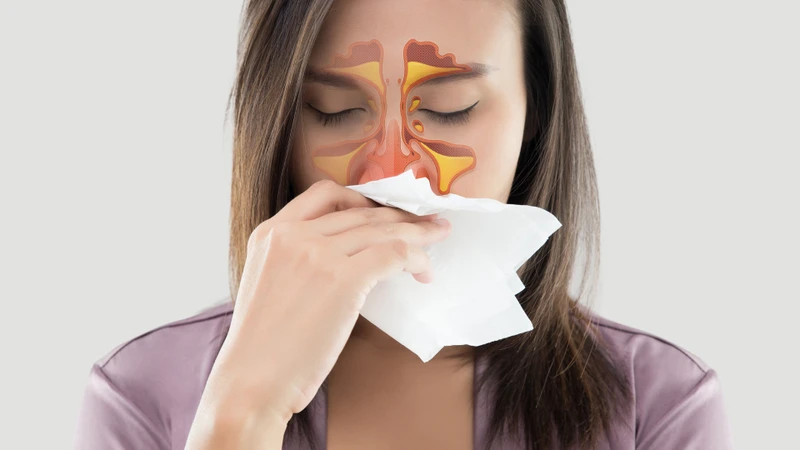 Các bất thường như vẹo vách ngăn mũi, polyp mũi hoặc cấu trúc xoang bất thường có thể làm cản trở dẫn lưu xoang