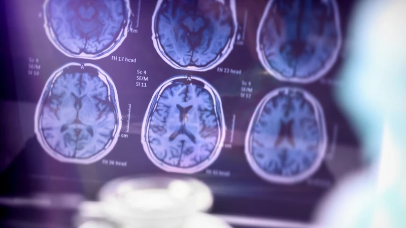 Sử dụng các phương pháp chẩn đoán hình ảnh như chụp CT hoặc MRI sọ não