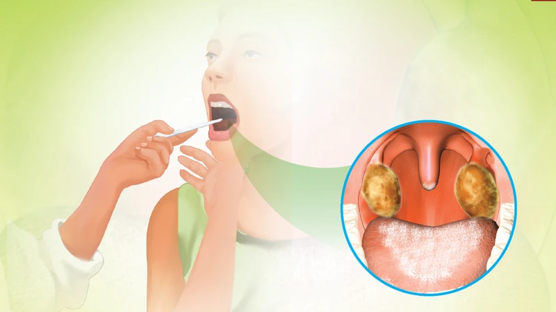 Bệnh bạch hầu có tái phát không? Nguyên nhân và yếu tố nguy cơ khiến bệnh bạch hầu tái phát 1