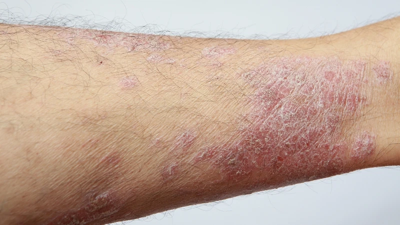 Bệnh da do nấm sợi lây qua tiếp xúc và dễ phát sinh khi da ẩm, suy giảm miễn dịch