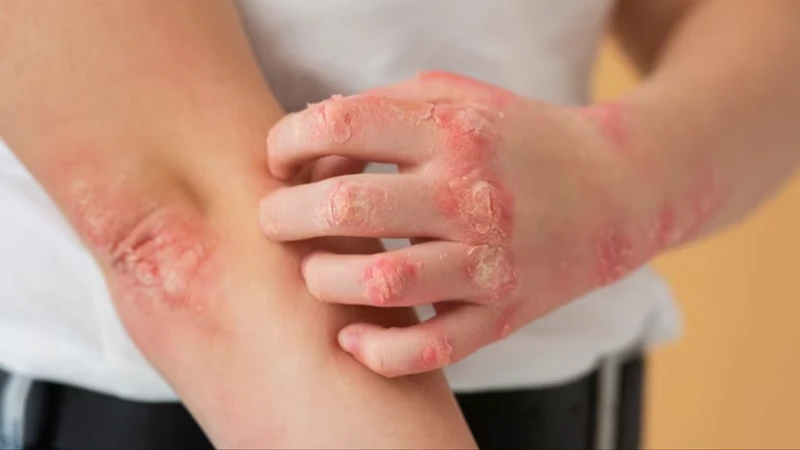 Bệnh ghẻ xốn: Nguyên nhân và cách phòng ngừa hiệu quả 2
