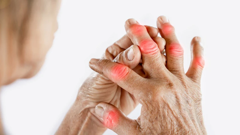 Hiểu rõ bệnh gout mãn tính giúp kiểm soát bệnh và hạn chế biến chứng