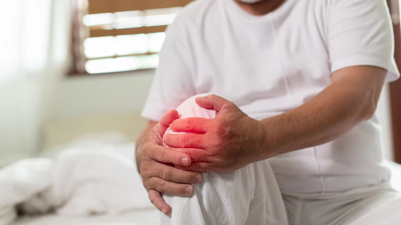 Bệnh gout mãn tính có thể gây hạt tophi và tổn thương khớp kéo dài