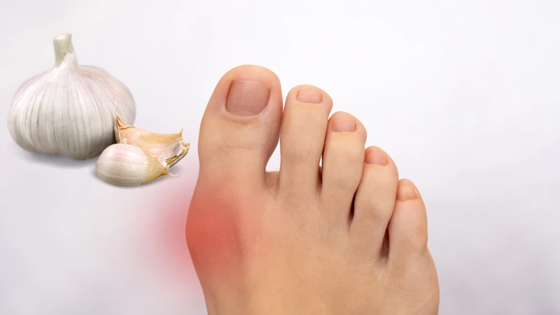 Người bệnh gút nên dùng tỏi vừa phải và tuân thủ chỉ định của bác sĩ