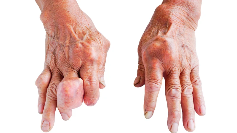 Bệnh gút hình thành do axit uric tích tụ, tạo tinh thể urat lắng đọng ở khớp
