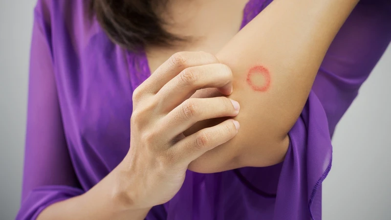 Bệnh hắc lào​ là gì? Triệu chứng và phương pháp điều trị 1.jpg