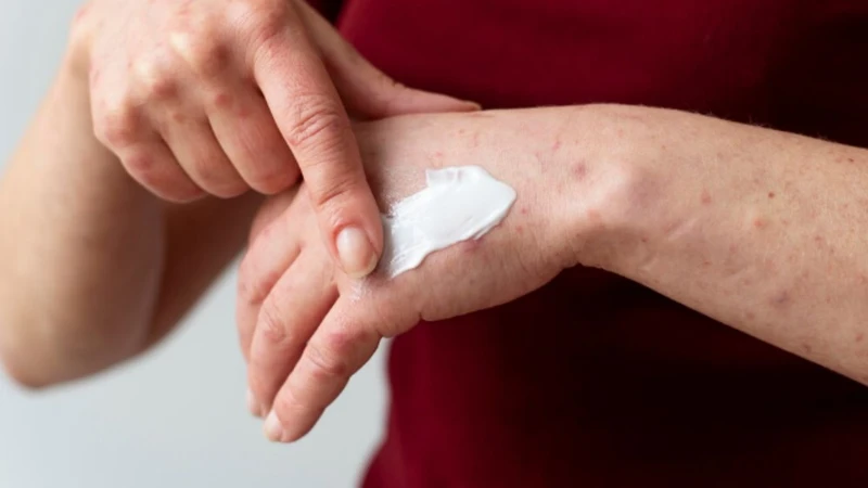 Bệnh hắc lào có lây không​? Những ai có nguy cơ bị hắc lào? 4