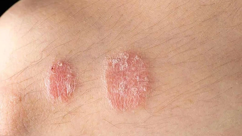 Bệnh hắc lào có tự khỏi không​? 4