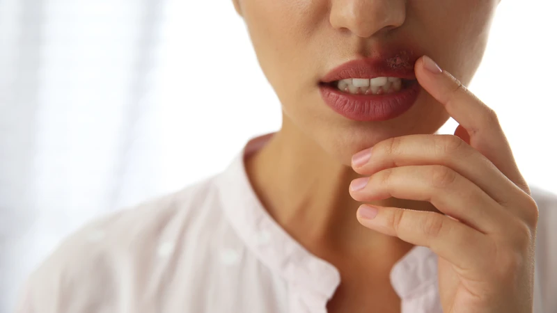 Vì herpes môi có xu hướng tái phát nhiều lần, việc chủ động phòng ngừa đóng vai trò rất quan trọng