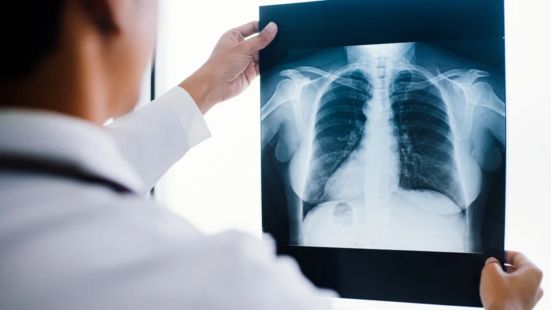 Chẩn đoán sớm qua xét nghiệm và X-quang phổi rất quan trọng
