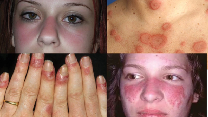 Bệnh lupus ban đỏ có nguy hiểm không​? Những biến chứng nguy hiểm của bệnh 1