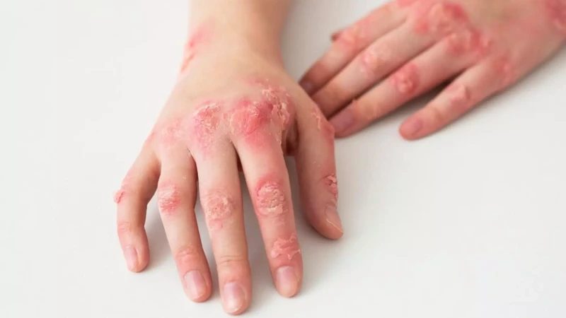Bệnh lupus ban đỏ có nguy hiểm không​? Những biến chứng nguy hiểm của bệnh 2