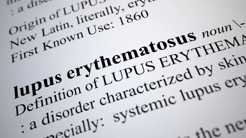 Bệnh lupus ban đỏ giai đoạn đầu: Dấu hiệu, chẩn đoán và điều trị 1