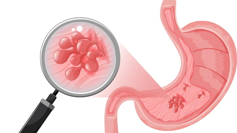 Bệnh nhân bị polyp dạ dày có nguy hiểm không​? 4