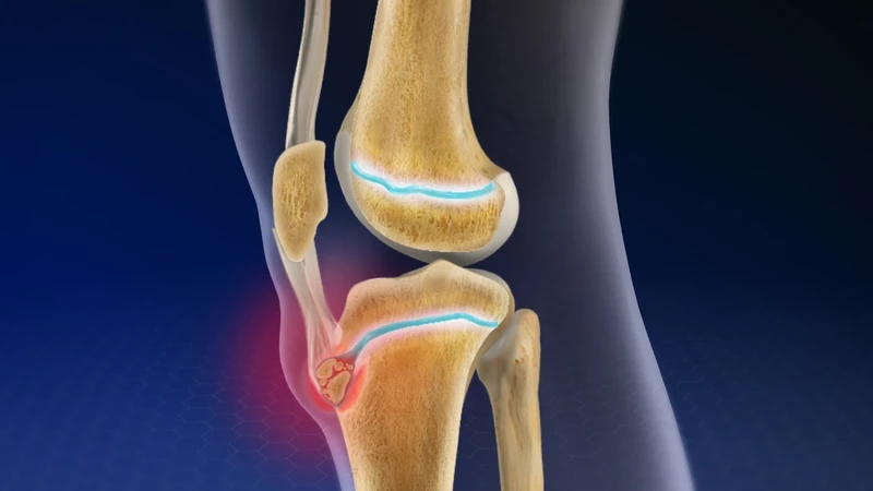 Bệnh Osgood-Schlatter có thể tự khỏi mà không cần can thiệp điều trị phức tạp