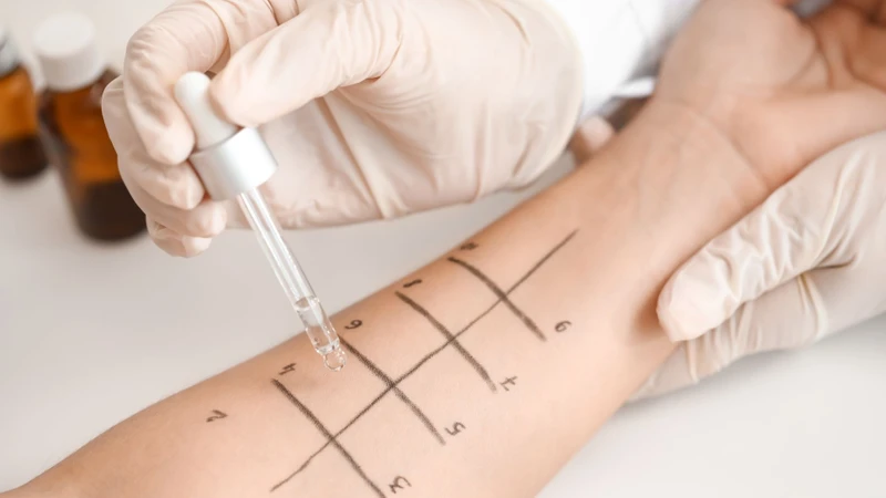 Test lẩy da giúp phát hiện các chất gây dị ứng khác nhau