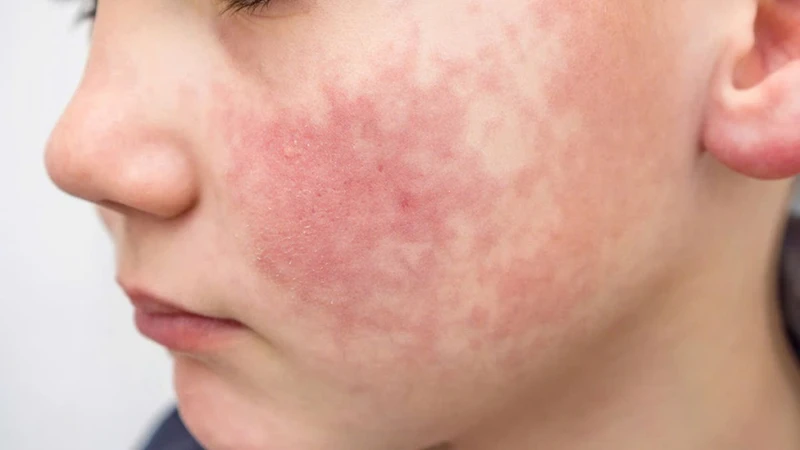 benh-rubella-va-nhung-thong-tin-can-biet  2.jpg