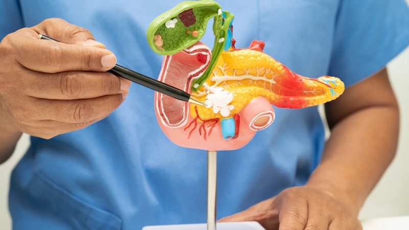 Polyp túi mật là các tổn thương dạng u phát triển trên niêm mạc túi mật
