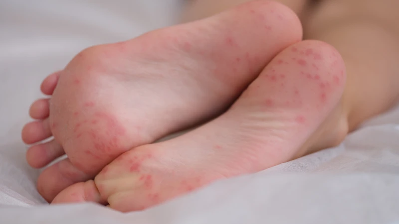 Bệnh tay chân miệng cấp độ 1: Dấu hiệu nhận biết và cách chăm sóc 2