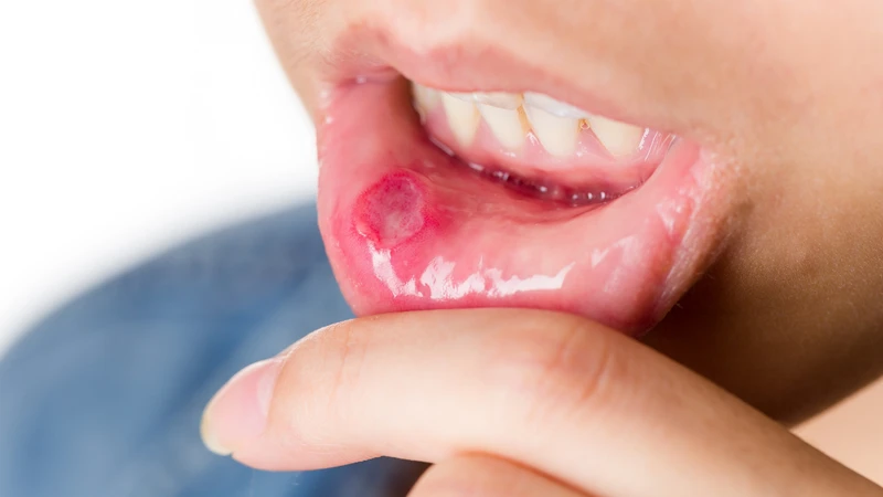 Bệnh tay chân miệng nổi mụn nước nhiều có sao không? 4