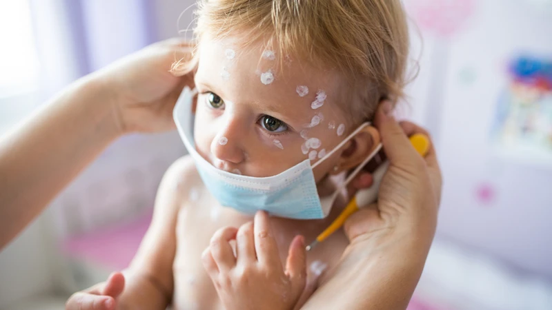 Bệnh thủy đậu thường bị vào mùa nào? 2