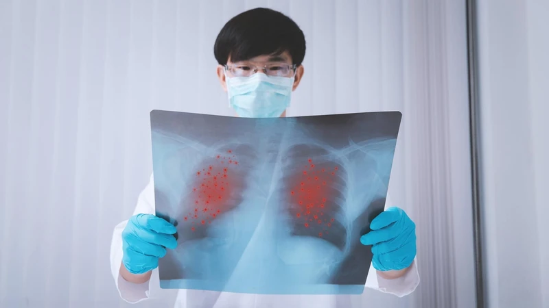 Bệnh ung thư phổi di căn có chữa được không? 2