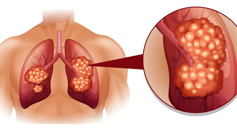 Bệnh ung thư phổi giai đoạn 4 nguy hiểm như thế nào? 4