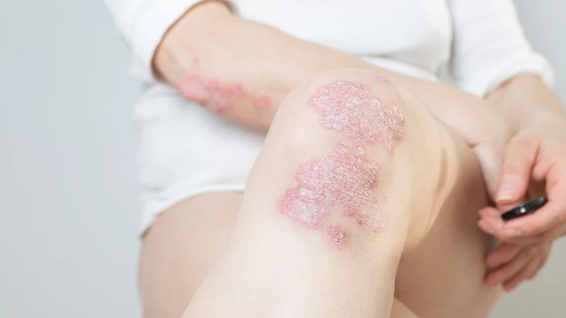 Bệnh vảy nến ở chân là một rối loạn tự miễn khiến tế bào da sản sinh quá nhanh, tạo thành các mảng dày, đỏ, bong tróc