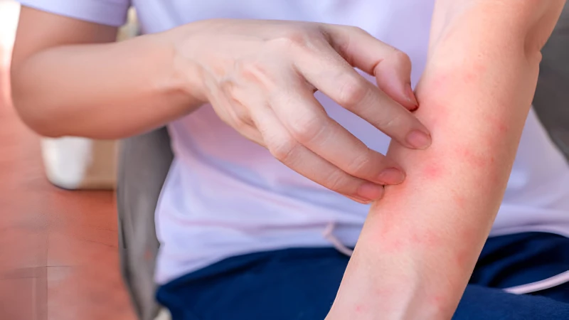 Bệnh viêm não mô cầu ở người lớn: Dấu hiệu, nguy cơ và cách phòng ngừa 2