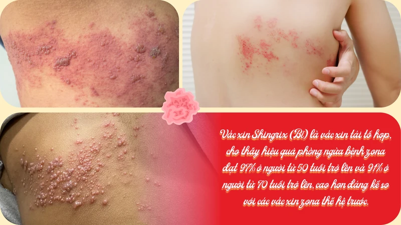 benh-zona-co-lay-khong-va-co-nen-kieng-gio-5.png