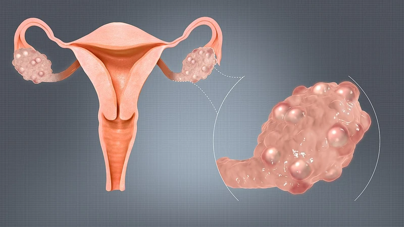 Béo phì độ 3 là gì? Những biến chứng nguy hiểm khi không điều trị 2.jpg