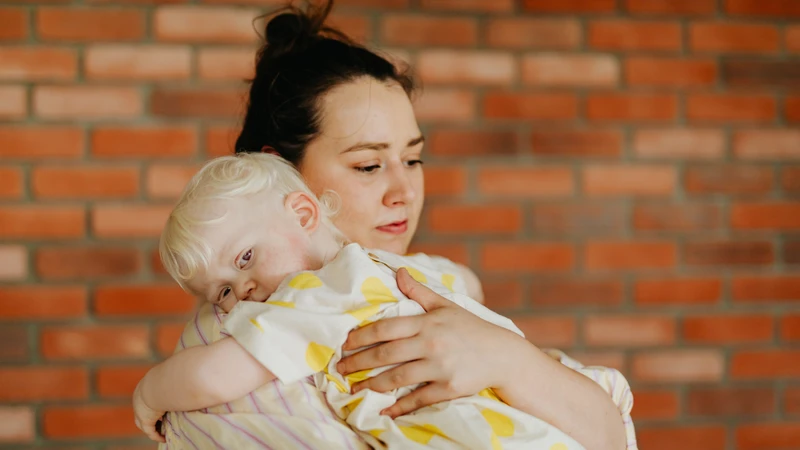 Bệnh bạch tạng gây nguy cơ tổn thương da và ung thư da cao