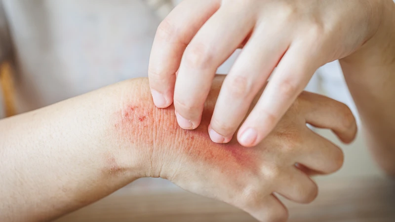 Các biểu hiện khi bị bọ xít tiểu vào da, từ cảm giác đau rát đến tổn thương nghiêm trọng