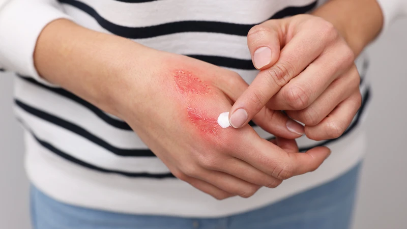 Bị bọ xít tiểu vào da bôi thuốc gì? Corticosteroid giúp giảm viêm, làm dịu phản ứng trên da