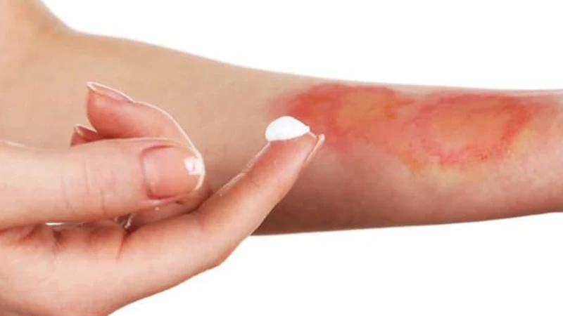 Tuyệt đối không bôi kem đánh răng hay các chất lạ lên vết bỏng