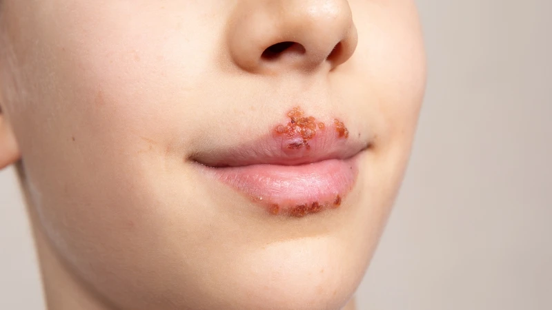 Bị giời leo ở miệng bôi gì để nhanh khỏi? Hướng dẫn điều trị và phòng ngừa 1