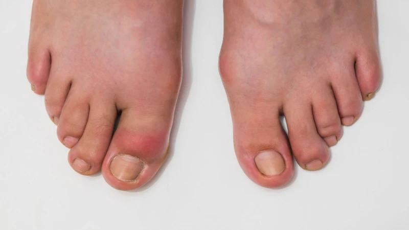 Bị gout đau ở đâu nhiều nhất? Khớp ngón chân cái là vị trí phổ biến nhất