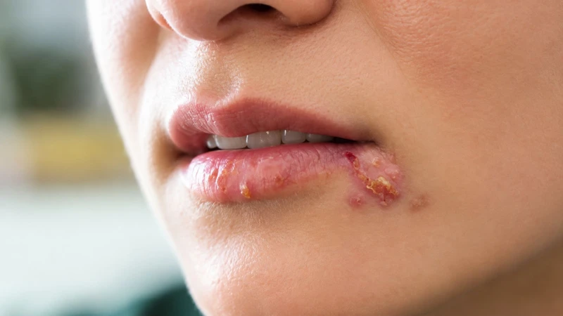 Sai lầm khi chăm sóc herpes môi