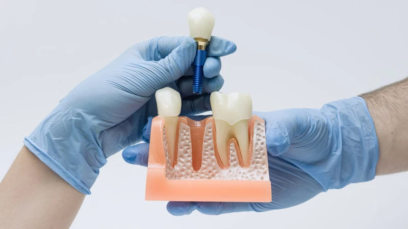 Cấy ghép Implant có thể giúp hạn chế tình trạng tiêu xương hàm sau mất răng