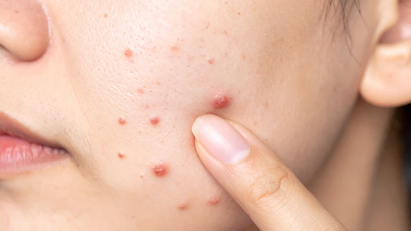 Bị mụn nhọt có nên nặn không và các trường hợp cần tránh tuyệt đối