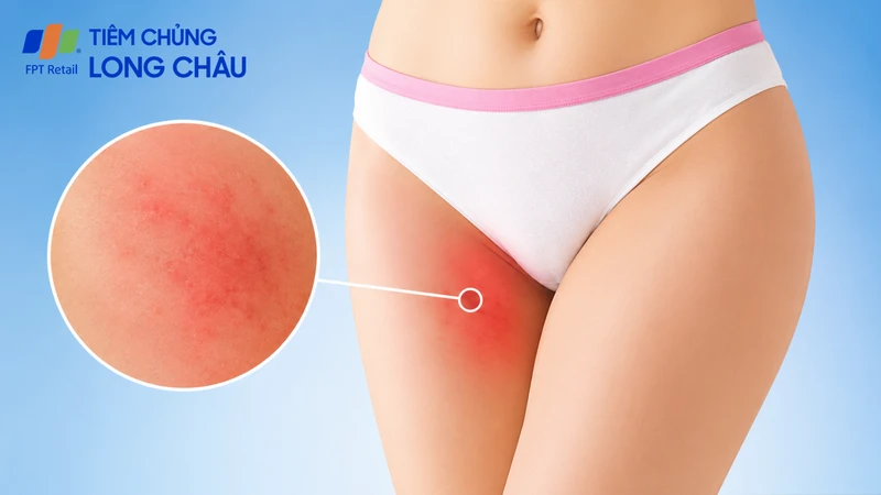 Ngứa vùng kín có thể do kích ứng, dị ứng hoặc nhiễm trùng